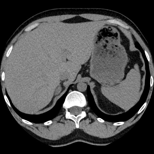 Adrenal gland trauma (Radiopaedia 81351-95079 Axial non-contrast 23).jpg