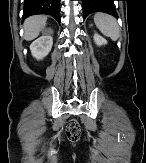 Adrenal lymphoma (Radiopaedia 73730-84529 Coronal C+ portal venous phase 66).jpg