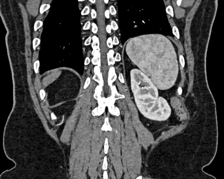 File:Adrenal metastases (Radiopaedia 73082-83791 Coronal C+ arterial phase 71).jpg