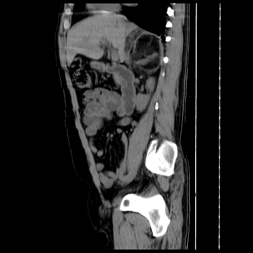 File:Adrenal myelolipoma (Radiopaedia 41843-44834 Sagittal non-contrast 16).jpg