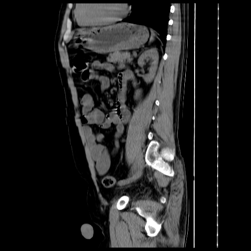 File:Adrenal myelolipoma (Radiopaedia 41843-44834 Sagittal non-contrast 27).jpg