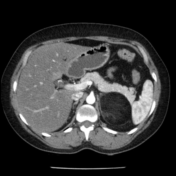 Adrenal myelolipoma (Radiopaedia 43401-46759 Axial C+ arterial phase 29).jpg