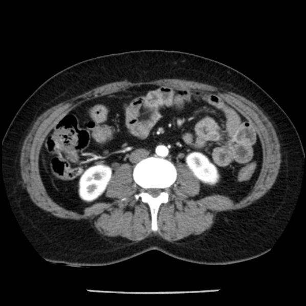 Adrenal myelolipoma (Radiopaedia 43401-46759 Axial C+ arterial phase 56).jpg