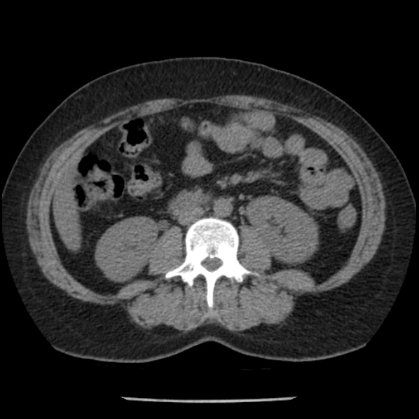 File:Adrenal myelolipoma (Radiopaedia 43401-46759 Axial non-contrast 44).jpg
