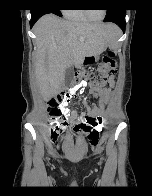 Adrenal myelolipoma - bilateral (Radiopaedia 74805-85810 Coronal C+ portal venous phase 204).jpg