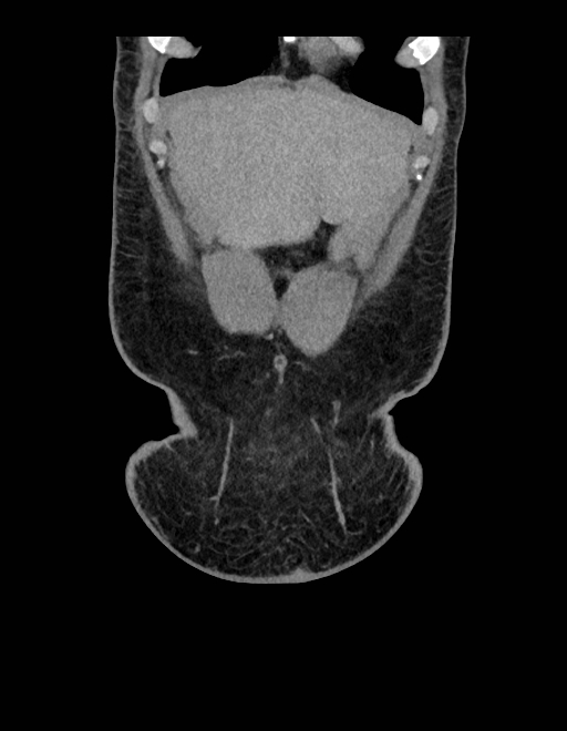 Adrenal myelolipoma - bilateral (Radiopaedia 74805-85810 Coronal C+ portal venous phase 237).jpg