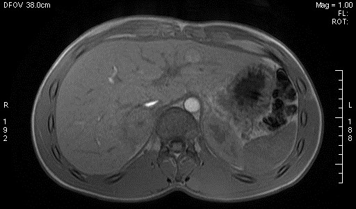 File:Adrenal pheochromocytoma (Radiopaedia 35133-36730 Axial T1 out-of-phase 2).jpg