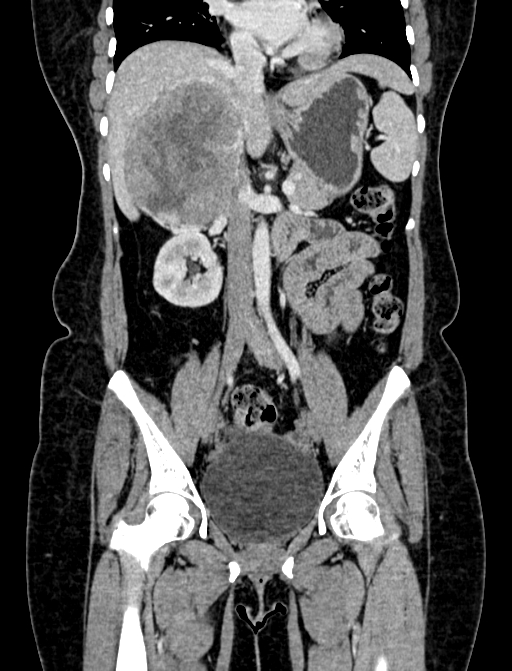 Adrenocortical carcinoma (Radiopaedia 87281-103569 Coronal C+ portal venous phase 45).jpg