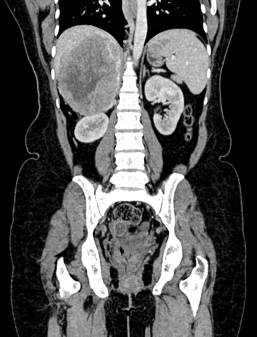 Adrenocortical carcinoma (Radiopaedia 87281-103569 Coronal C+ portal venous phase 81).jpg