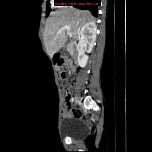 File:Adrenocortical carcinoma (Radiopaedia 9449-10131 Sagittal C+ portal venous phase 2).jpg