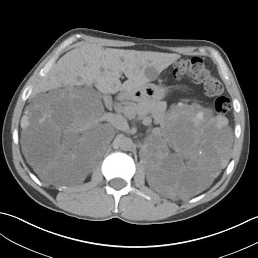 File:Adult polycystic kidney disease (Radiopaedia 47866-52626 Axial non-contrast 26).png