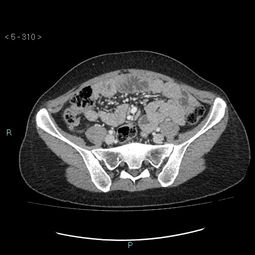 Adult transient intestinal intussusception (Radiopaedia 34853-36310 Axial C+ portal venous phase 73).jpg
