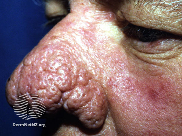 File:Advanced rhinophyma (DermNet NZ acne-rosacea5).jpg