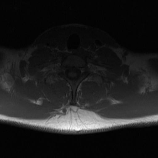 File:Aggressive vertebral hemangioma (Radiopaedia 39937-42404 Axial T1 40).png