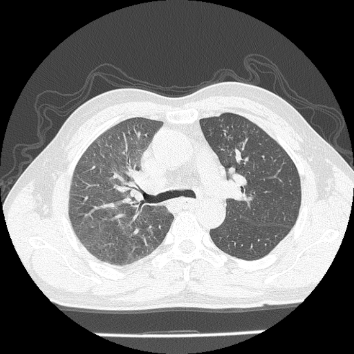Airway foreign body in adult (Radiopaedia 85907-101779 Axial lung window 56).jpg