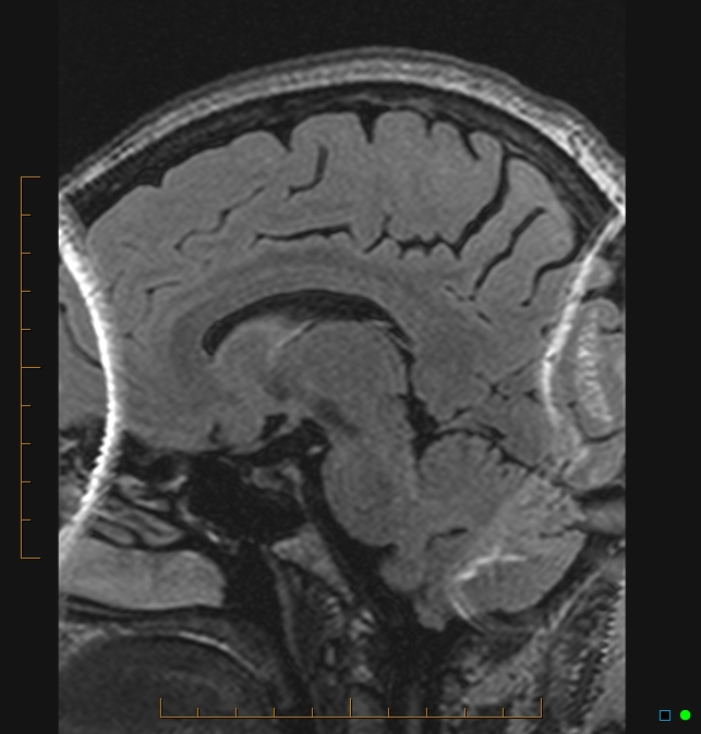 Aliasing artifact causing a spurious cerebellar lesion (Radiopaedia 48783-53810 Sagittal FLAIR 58).jpg