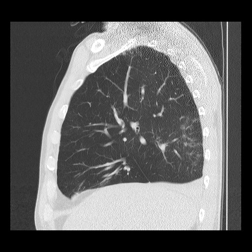 Allergic bronchopulmonary aspergillosis (ABPA) (Radiopaedia 60594-68313 Sagittal lung window 42).jpg