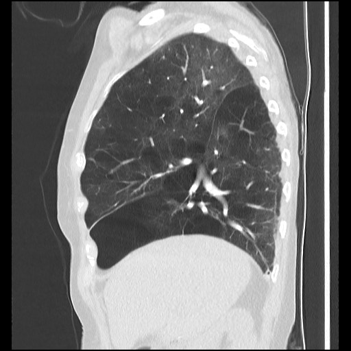 Alpha-1-antitrypsin deficiency (Radiopaedia 64893-73840 Sagittal lung window 16).jpg
