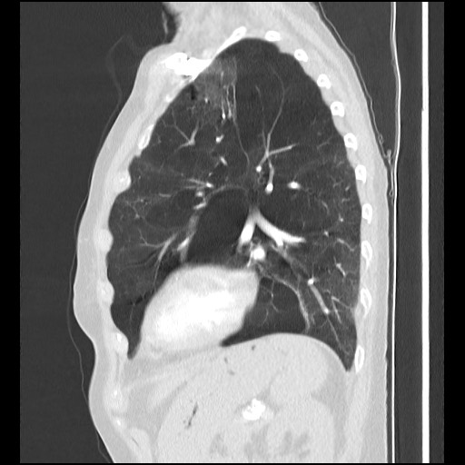 Alpha-1-antitrypsin deficiency (Radiopaedia 64893-73840 Sagittal lung window 40).jpg
