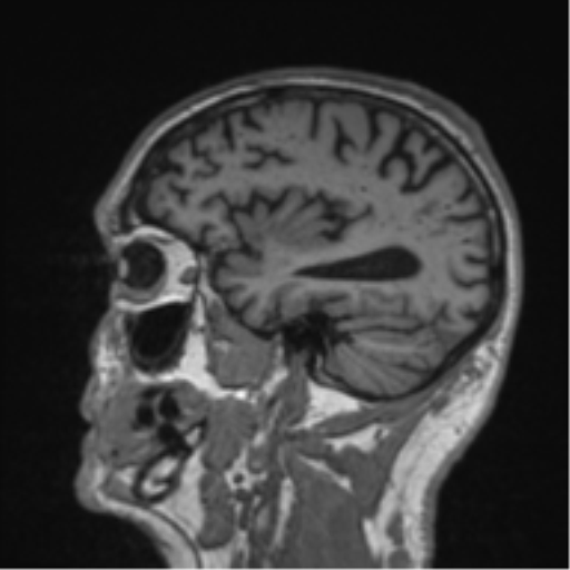 Alzheimer's disease- with Gerstmann syndrome and dressing apraxia (Radiopaedia 54882-61150 Sagittal T1 17).png