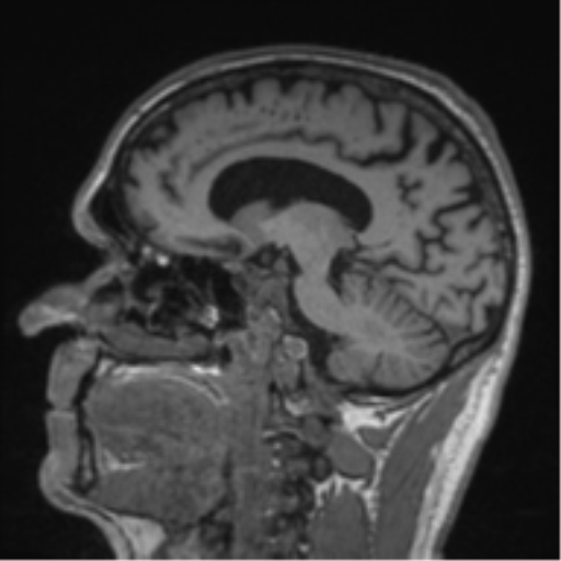 File:Alzheimer's disease- with Gerstmann syndrome and dressing apraxia (Radiopaedia 54882-61150 Sagittal T1 29).png