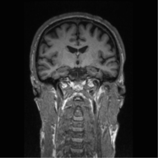 Alzheimer disease - probable (Radiopaedia 35334-36837 Coronal T1 48).png
