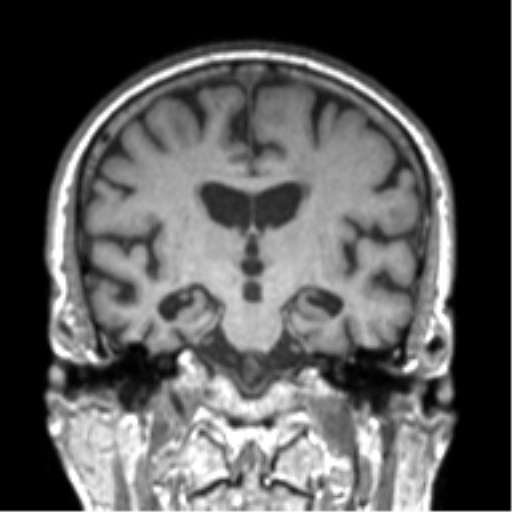 Alzheimer disease and cerebral amyloid angiopathy (Radiopaedia 64234-73011 Coronal T1 32).png