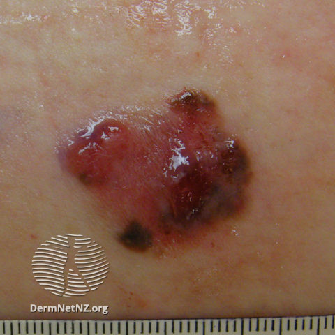 File:Amelanotic melanoma (DermNet NZ amelanotic-melanoma-25-of-125).jpg