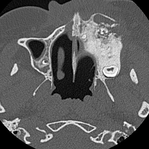 Ameloblastic fibro-odontoma (Radiopaedia 18843-18780 C 30).jpg