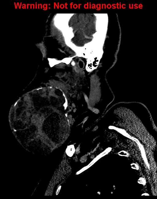 Ameloblastoma (Radiopaedia 33126-34164 F 15).jpg