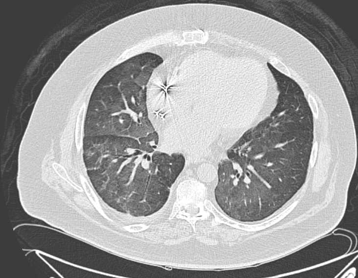File:Amiodarone lung (Radiopaedia 62514-70769 Axial lung window 55).jpg