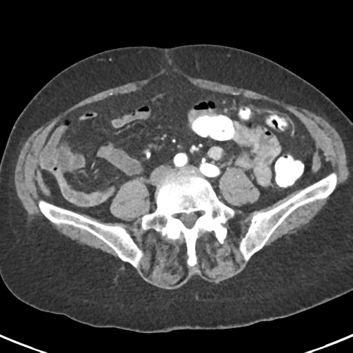 Ampullary adenocarcinoma (Radiopaedia 34013-35237 B 66).png