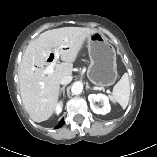 Ampullary adenocarcinoma (Radiopaedia 34013-35237 C 10).png