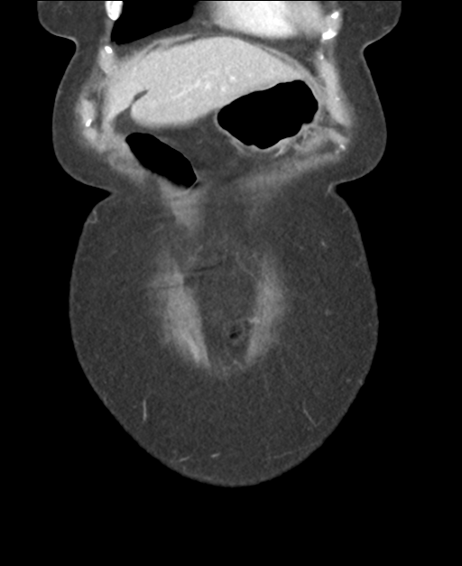 Ampullary adenocarcinoma (Radiopaedia 34013-35237 E 10).png