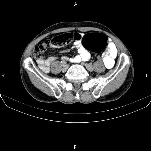 Ampullary adenocarcinoma (Radiopaedia 86093-102032 Axial C+ delayed 75).jpg