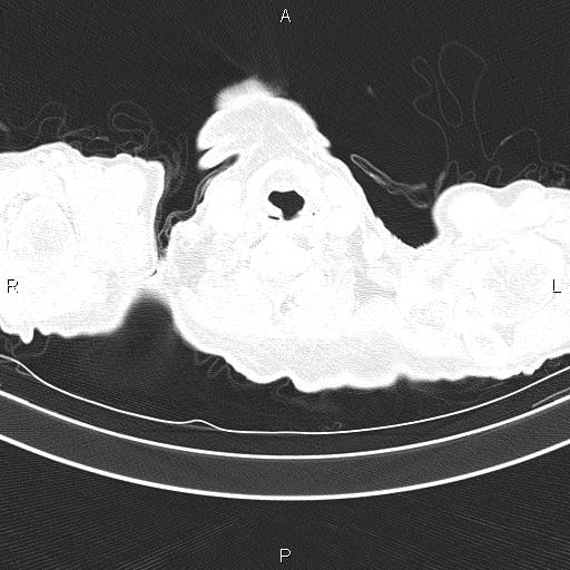 Ampullary adenocarcinoma (Radiopaedia 86093-102033 Axial lung window 5).jpg
