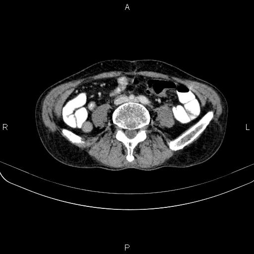 File:Ampullary adenocarcinoma (Radiopaedia 86093-102033 B 83).jpg