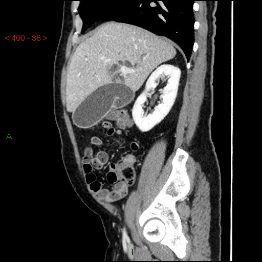 Ampullary carcinoma (Radiopaedia 56396-63056 D 35).jpg