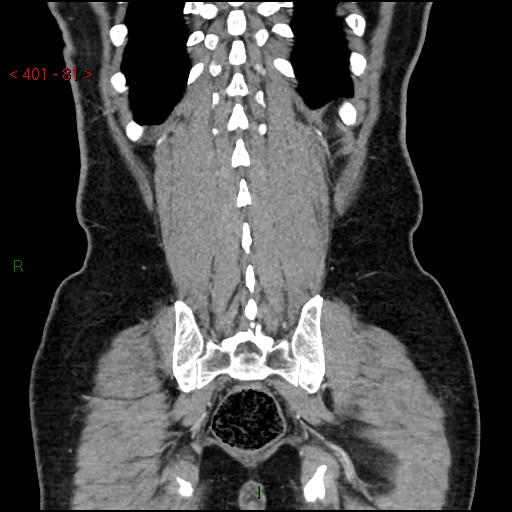 Ampullary carcinoma (Radiopaedia 56396-63056 E 80).jpg