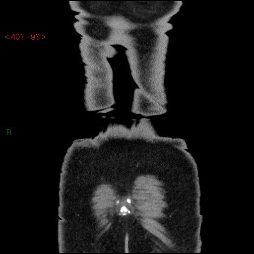 Ampullary carcinoma (Radiopaedia 56396-63056 E 92).jpg