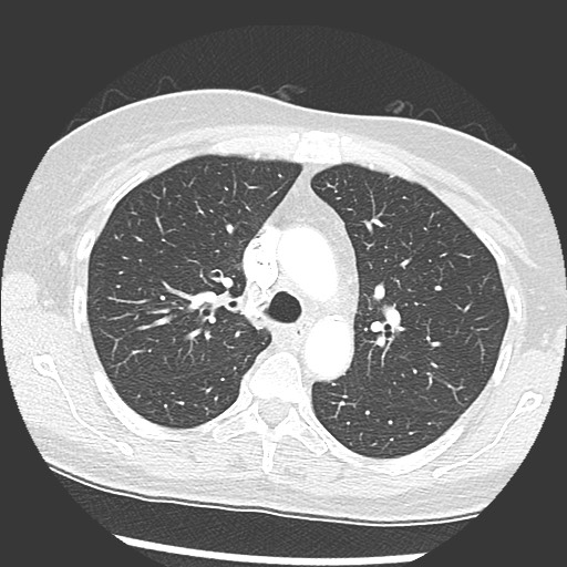 Amyloidosis - bronchial and diffuse nodular pulmonary involvement (Radiopaedia 60156-67745 Axial lung window 26).jpg