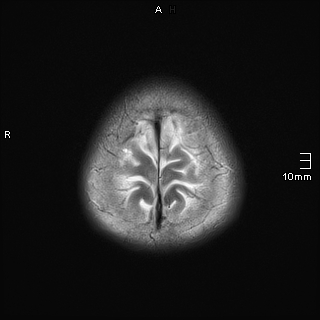 File:Amyotrophic lateral sclerosis (Radiopaedia 70821-81017 Axial T2 23).jpg
