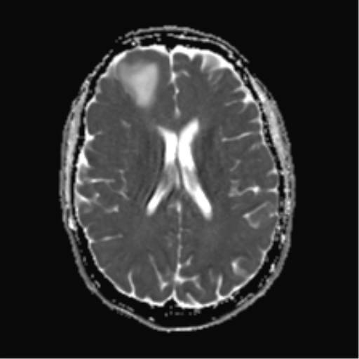 File:Anaplastic astrocytoma IDH mutant (Radiopaedia 50046-55341 Axial ADC 17).png