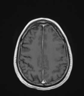 Anaplastic astrocytoma IDH wild-type (Radiopaedia 49984-55273 Axial T1 C+ 43).png