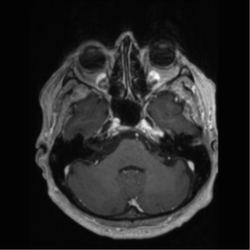 File:Anaplastic astrocytoma IDH wild-type (pseudoprogression) (Radiopaedia 42209-45277 Axial T1 C+ 27).png