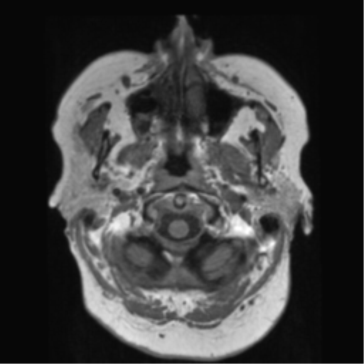 File:Anaplastic astrocytoma IDH wild-type (pseudoprogression) (Radiopaedia 42209-45278 Axial T1 20).png