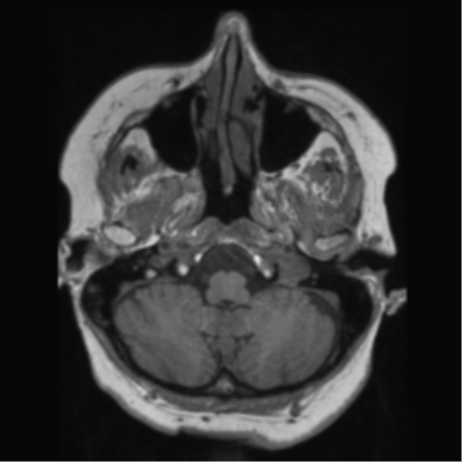 File:Anaplastic astrocytoma IDH wild-type (pseudoprogression) (Radiopaedia 42209-45278 Axial T1 36).png