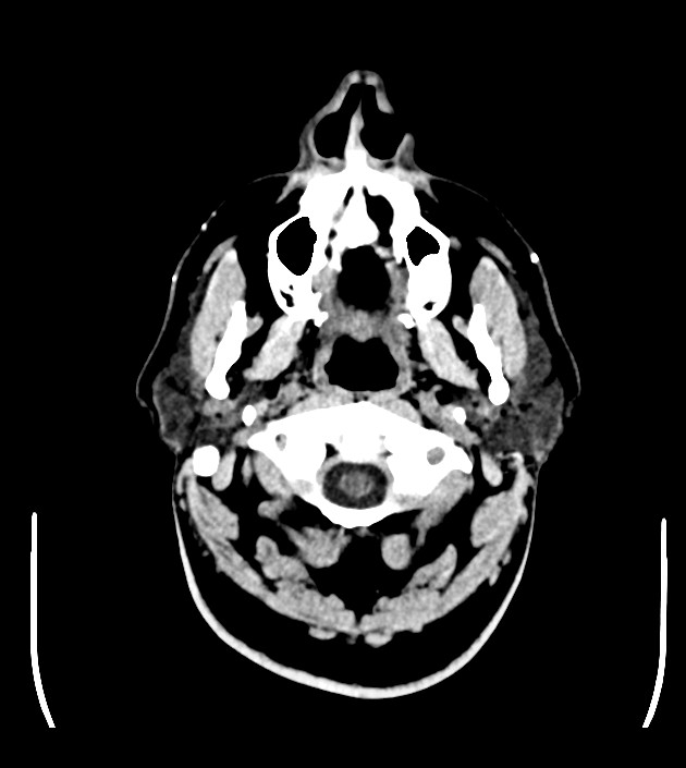 Anaplastic oligodendroglioma (Radiopaedia 79571-92753 Axial non-contrast 4).jpg