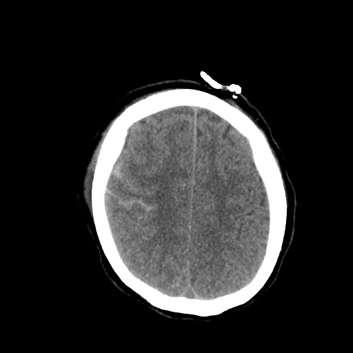 Aneursym related subarachnoid hemorrhage with hydrocephalus (Radiopaedia 45105-49085 Axial non-contrast 39).jpg