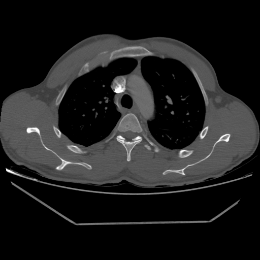 File:Aneurysmal bone cyst - rib (Radiopaedia 82167-96220 Axial bone window 95).jpg